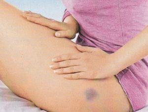 синяк на ноге