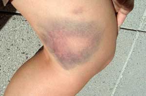 синяк на ноге