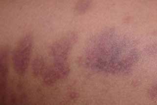 синяк на теле