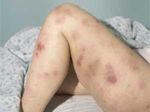 синяки на ногах