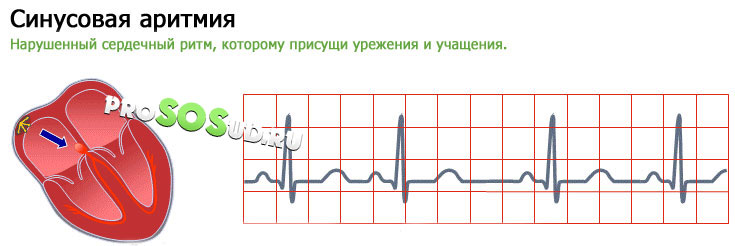 Синусовая аритмия