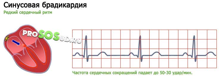 синусовая брадикардия