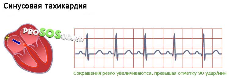 Синусовая тахикардия