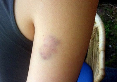 синяк на руке