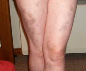 синяки ноги