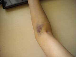 синяк после инъекции