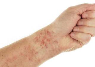 сыпь на руке