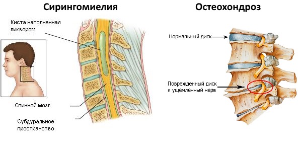 Эффективным препарат Сирдалуд МР будет при терапии позвоночных патологий