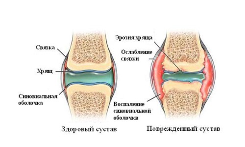 Наиболее часто камфорное масло используют при суставных патологиях