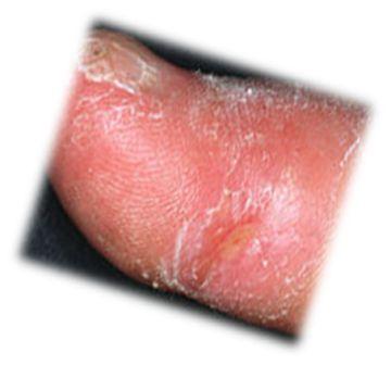 склеродермия на пальце