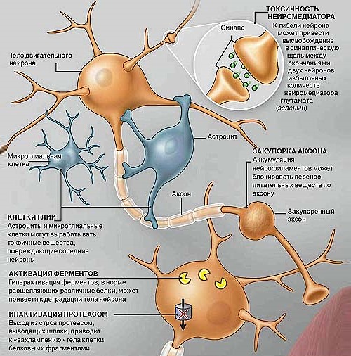 Существует несколько типов амиотрофического склероза, каждый из которого характеризуется своим протеканием