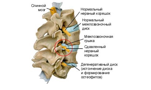 Операция при радикулите требуется, если возникла сильная компрессия корешка спинного мозга