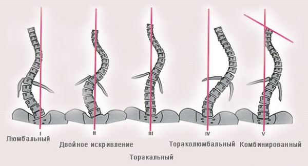 Независимо от локализации искривления позвоночника, симптомы всегда будут одинаковы