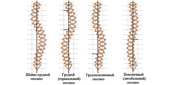 Обратите внимание на то, как выглядит сколиоз согласно классификации по местоположению