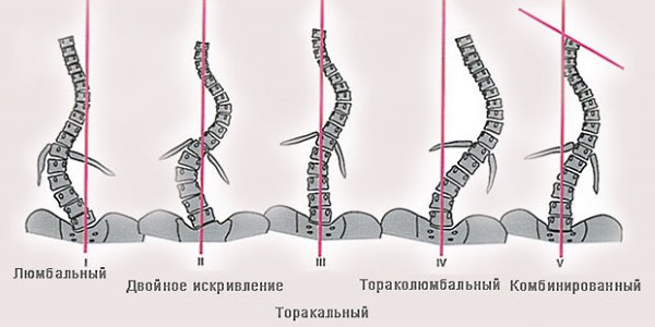 Классификация сколиоза по локализации искривления