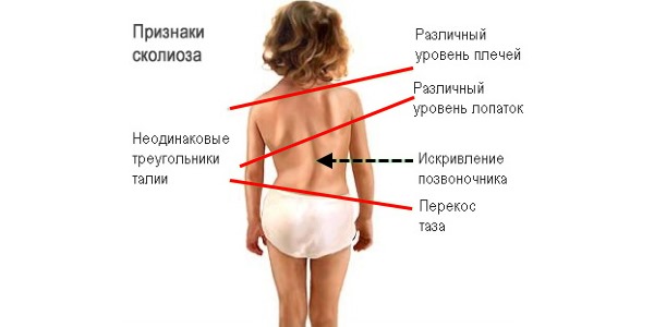 Для выявления сколиоза посмотрите на ребенка со спины