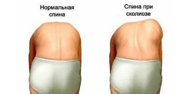 Чтобы распознать 2 степень сколиотического искривления, больному достаточно нагнуться вперед