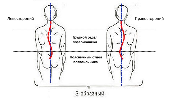 При S-образном сколиозе поражается одновременно грудной и поясничный отдел позвоночника