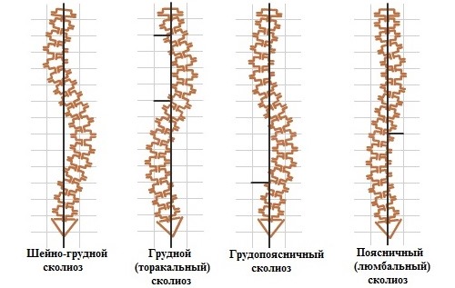 При сколиозе, степень которого превышает первую, подтягивания и висы на турнике противопоказаны