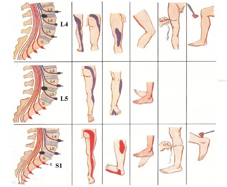 Обратите внимание на первые симптомы протрузии дисков поясничного отдела