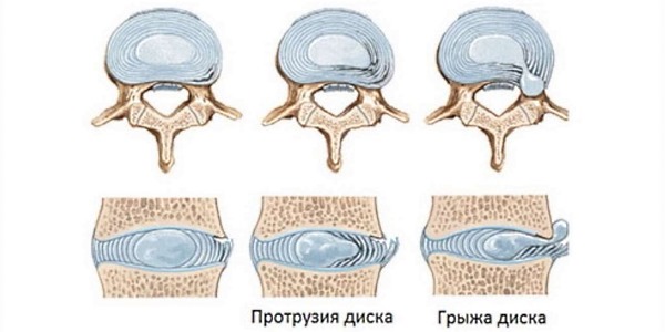 Дистрофические изменения в позвоночнике происходят по причине нарушения питания хрящевой ткани