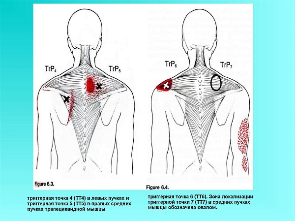 Триггерные точки бывают активными и латентными