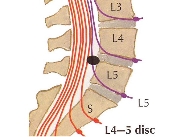 Межпозвоночная грыжа поясничного отдела - наиболее распространенная