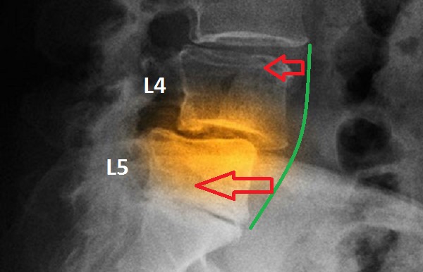 Для диагностики смещения обязательно делается рентген