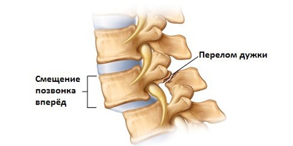 Смещение позвонков в грудном отделе приводит к ишемическим процессам