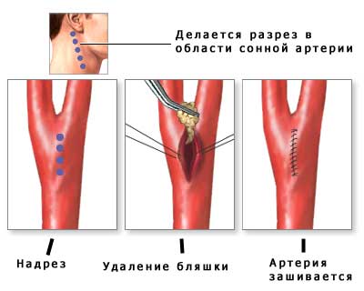 сонная артерия аперация