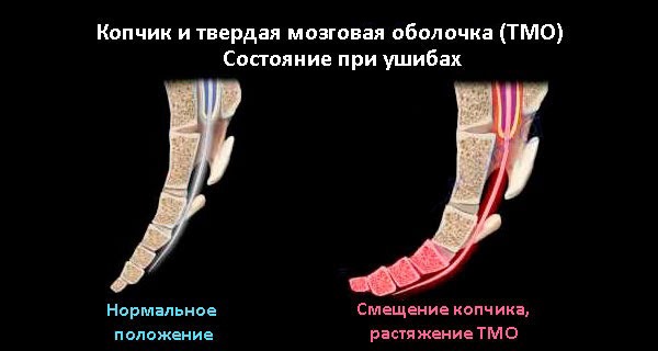 При ушибах копчика любого состояния требуется врачебная помощь