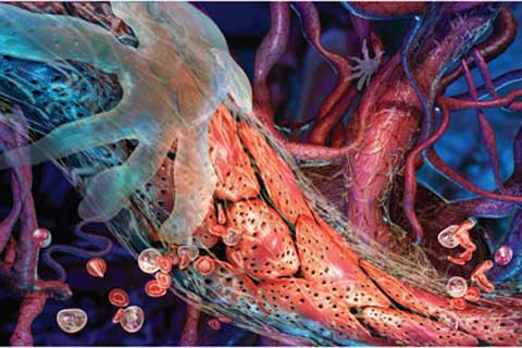 проблемные сосуды мозга