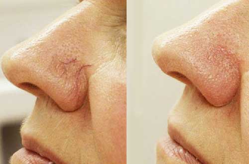 сосуды на носу