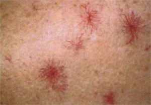 сосудистые пятна