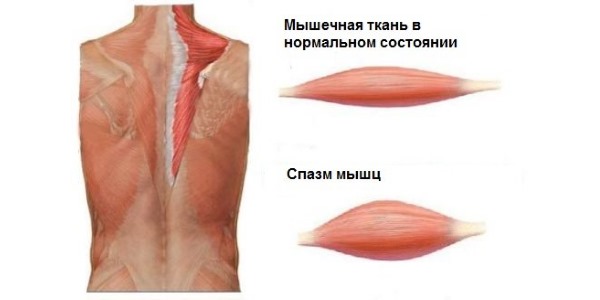 Основное назначение Толперила - гипертонус мышц