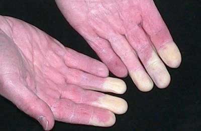 спазмы капиряров на руках