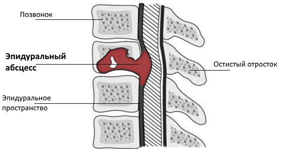 Спинальный эпидуральный абсцесс - гнойное воспаление эпидурального пространства