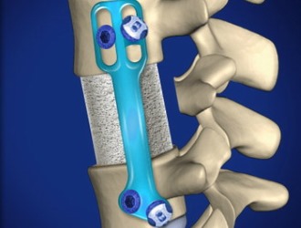 При операции на спондилолистезе производится фиксация позвонков с помощью пластин