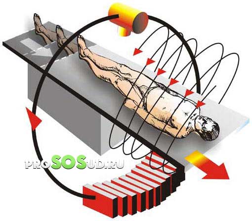 Спиральная томография