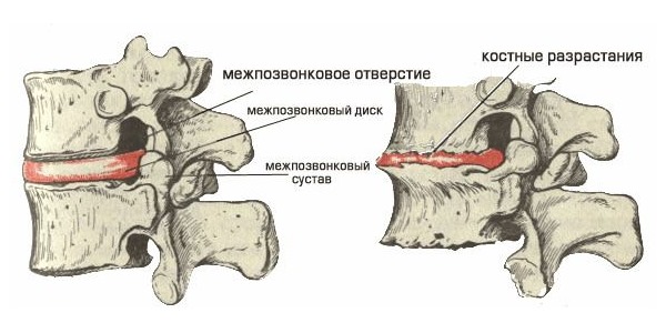 Остеофиты проявляются в виде костных наростов на позвонках