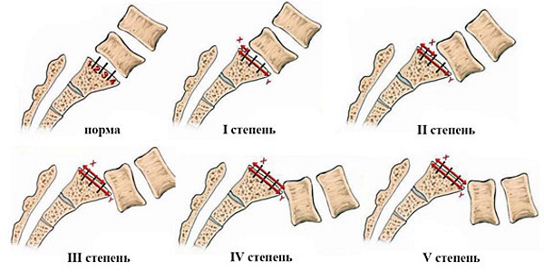 Стадии развития спондилолистеза (1-5)