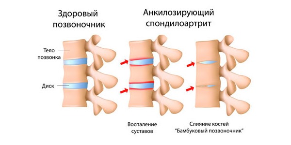 Болезнь Бехтерева - асептическое воспаление позвоночника