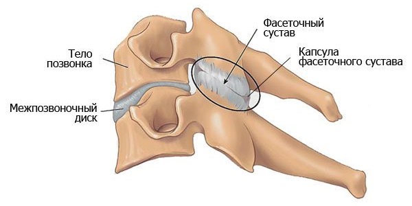 Метод деструкции фасеточных нервов используют для устранения болевого синдрома