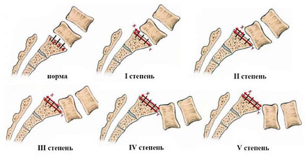 Степени смещения позвонков относительно друг друга при спондилолистезе