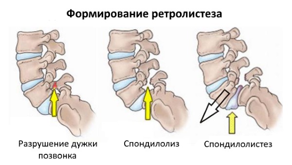 При ретролистезе L5 позвонка происходит нарушение в нервной и мышечной системе