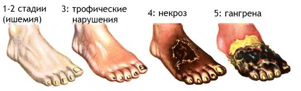 стадии эндартерита