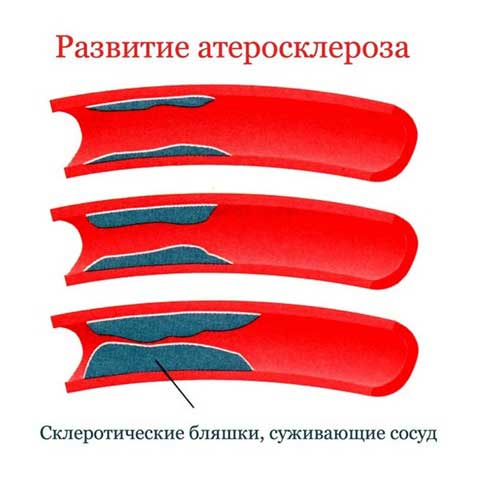 стадии атеросклероза