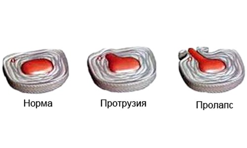 Боль в пояснице может возникнуть при развитии остеохондроза, который разрушает межпозвонковые диски