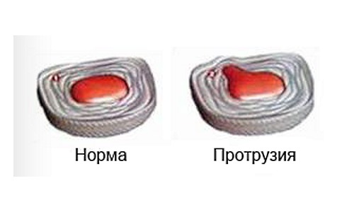 На начальной стадии во время лечения грыжи межпозвоночного диска можно обойтись без операции