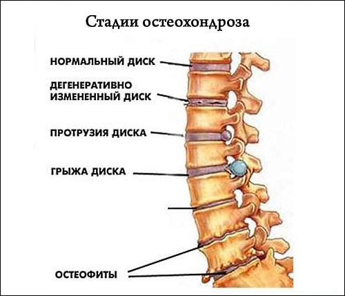 Препарат может быть назначен при дегенеративно-дистрофических изменениях в позвоночнике